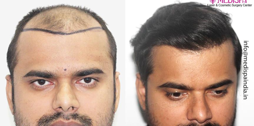 1 year hair transplant result
