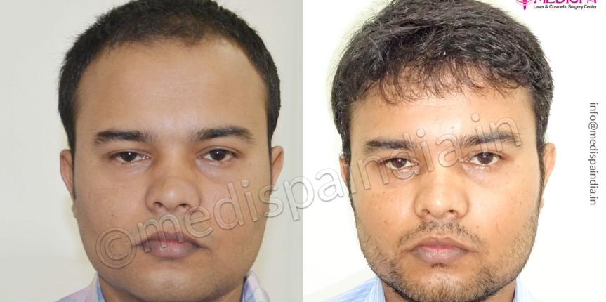 male hair transplant results india