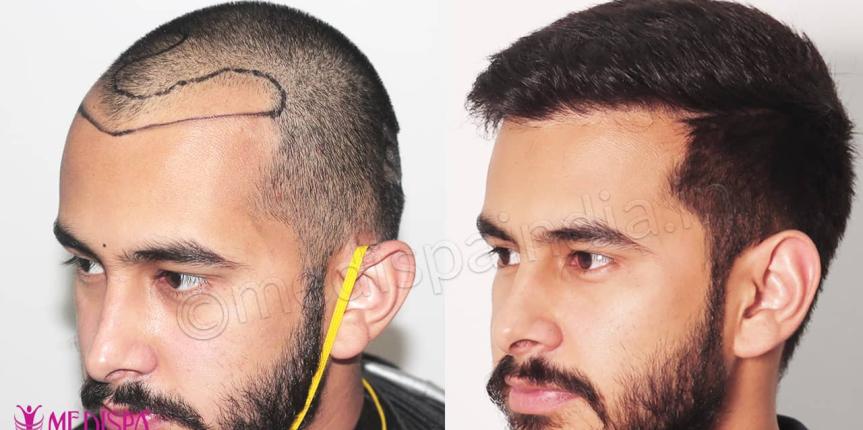 best hair transplant delhi