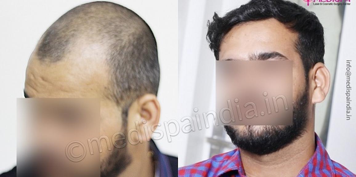 How To Know About Grade Of Baldness And How Hair Transplant Can Help?