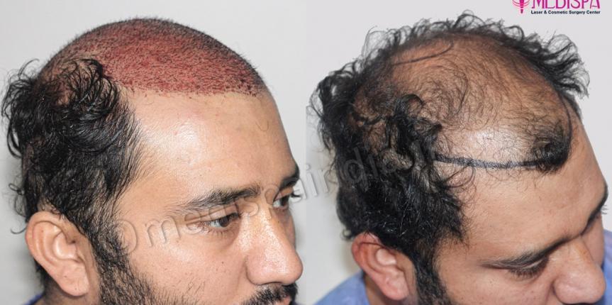 best hair transplant india result