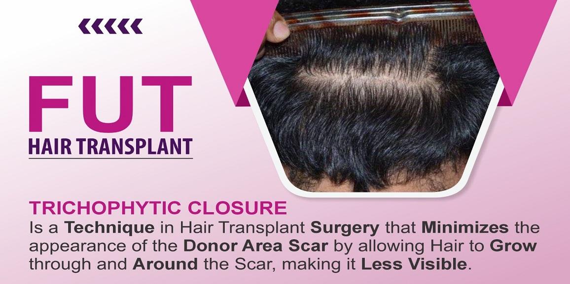 How FUT Hair Transplant Can Help Restoring Your Hair?