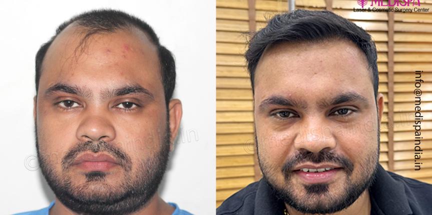 hair restoration delhi