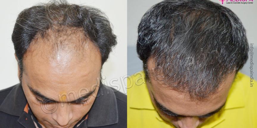 hair transplant cost in surat