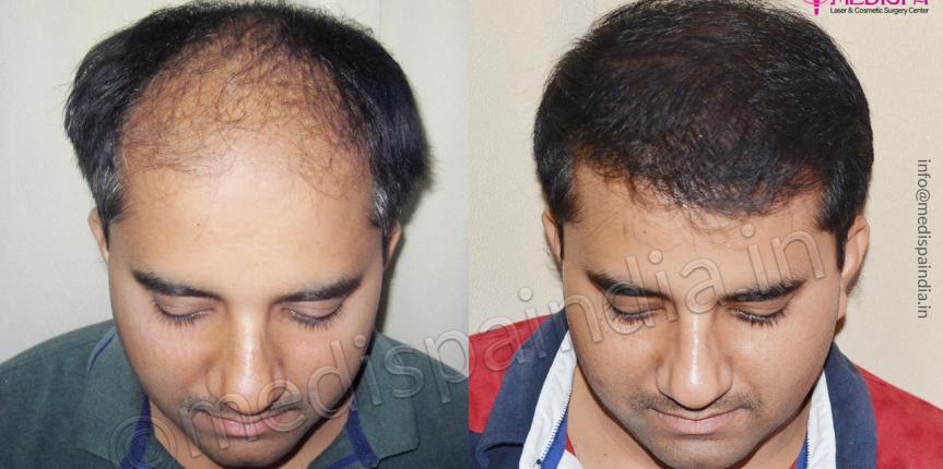 hair transplant clinics in turkey for repair