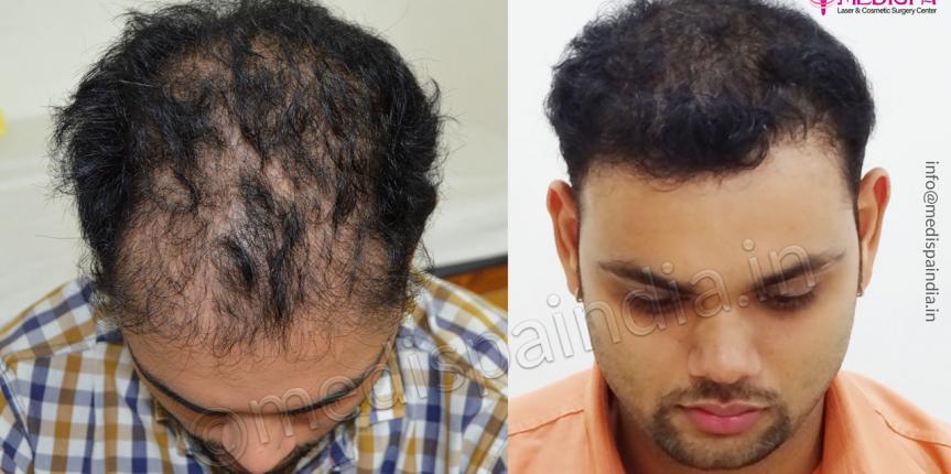 wrong hair transplant correction pune