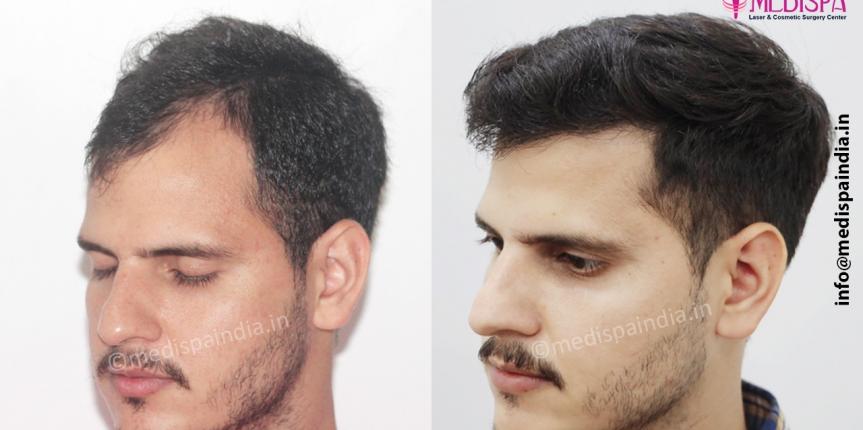 fue hair transplants