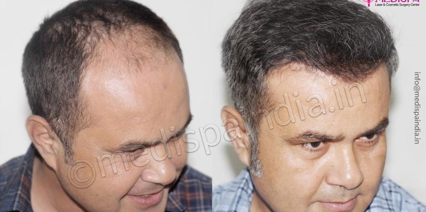 hair transplant dubai cost