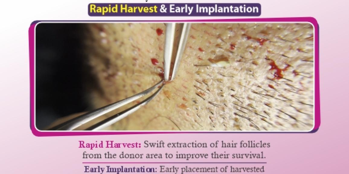 What is Rapid Harvest and Early Implantation Technique