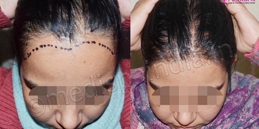 female hair transplant results delhi india