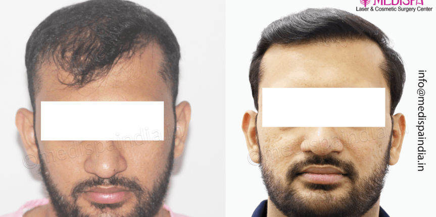 best-hair-restoration-india