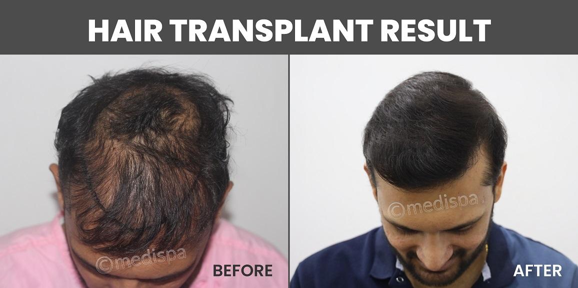 Hair Transplant: A Permanent Solution to Hair Loss