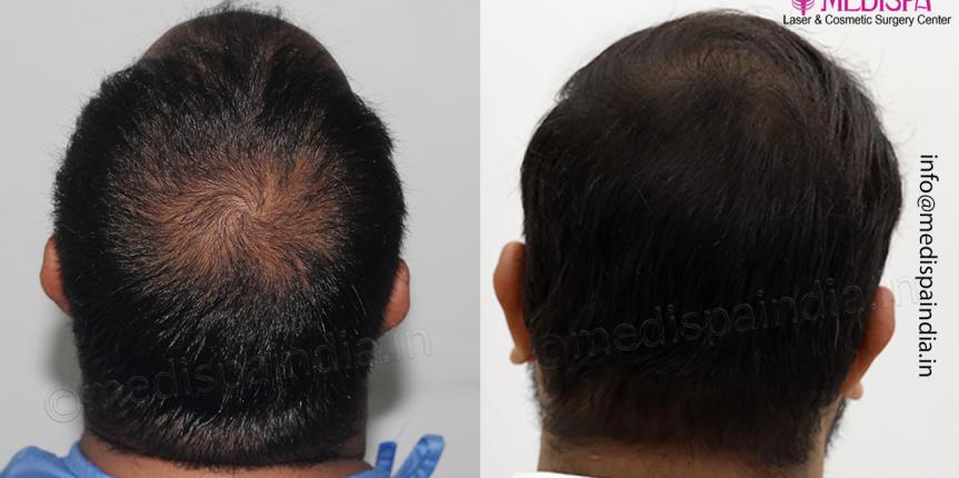 best hair restoration results india