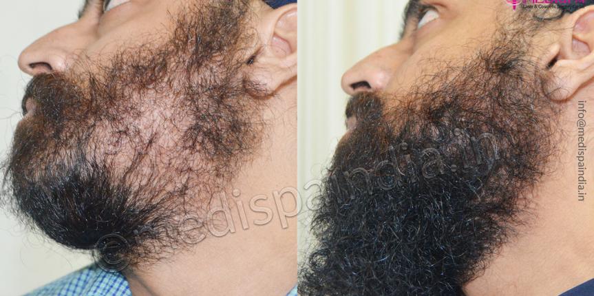 beard hair transplant result india