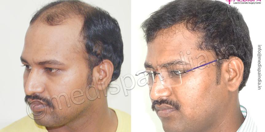 hair transplant cost in bangalore