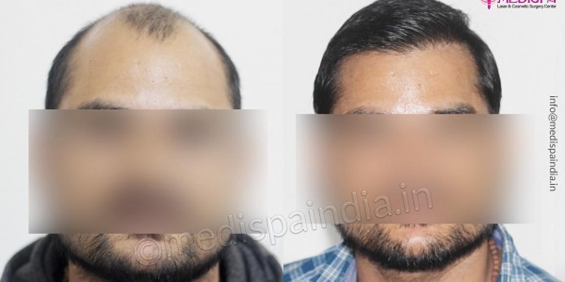 Is Hair Transplant An Effective Option To Cure Alopecia Areata?