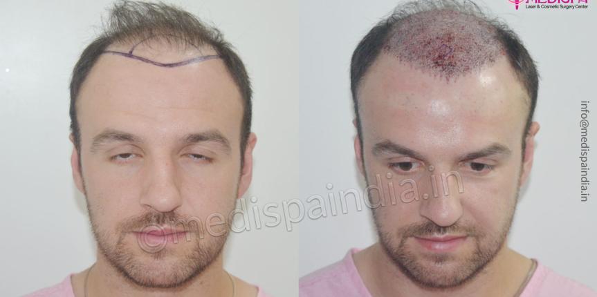 hair transplant ireland