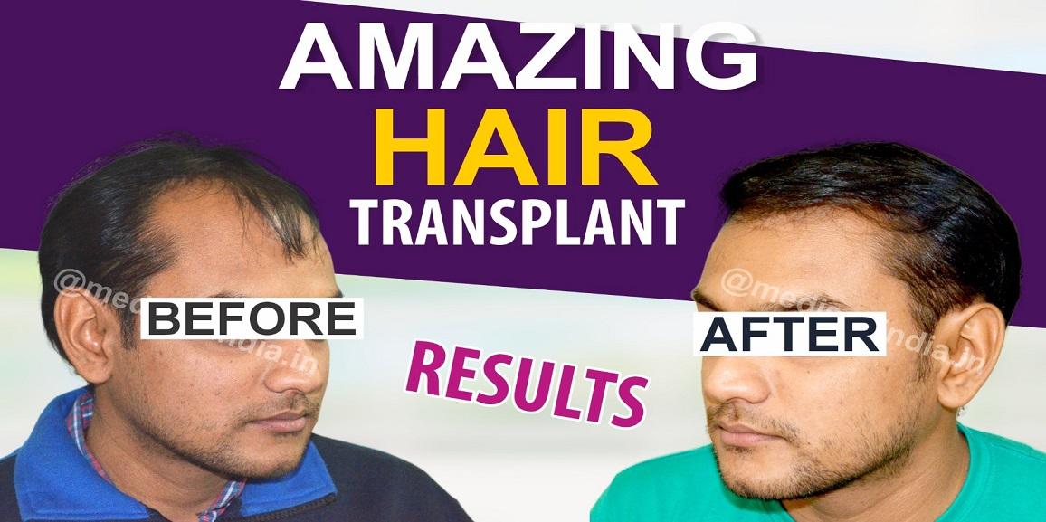 Factors To Be Taken Into Account While Opting Hair Transplant Surgery