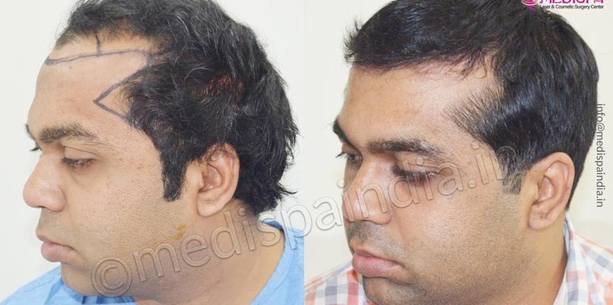 hair transplant in london uk