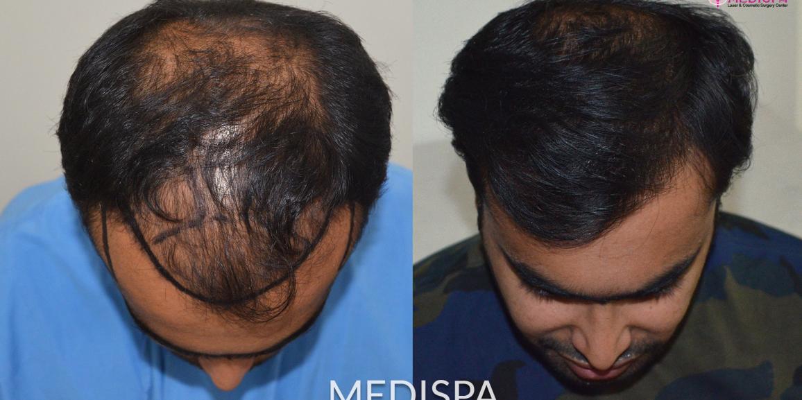 When it is needed to Have FUT+FUE technique of Hair Transplants