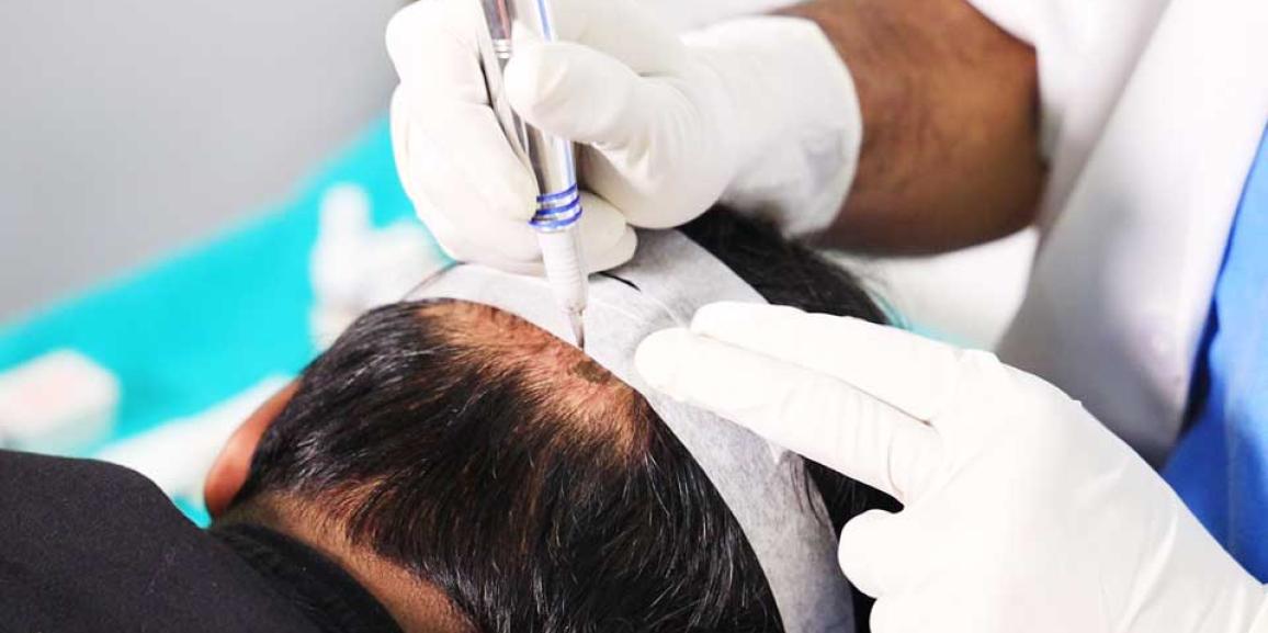 How Does Hair Transplant Differ in Men And Women?