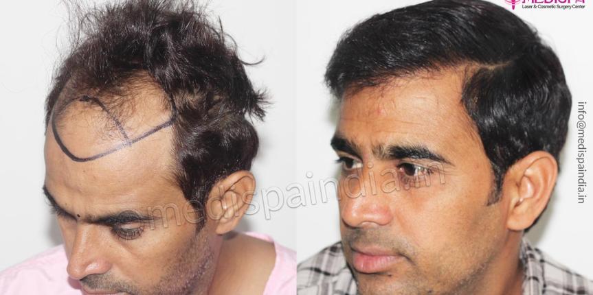 best hair transplant in jaipur rajasthan