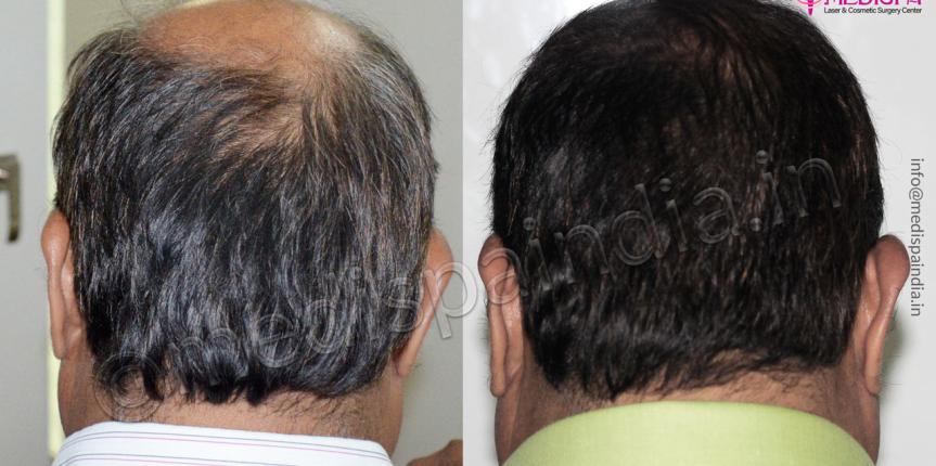 hair transplant cost dubai