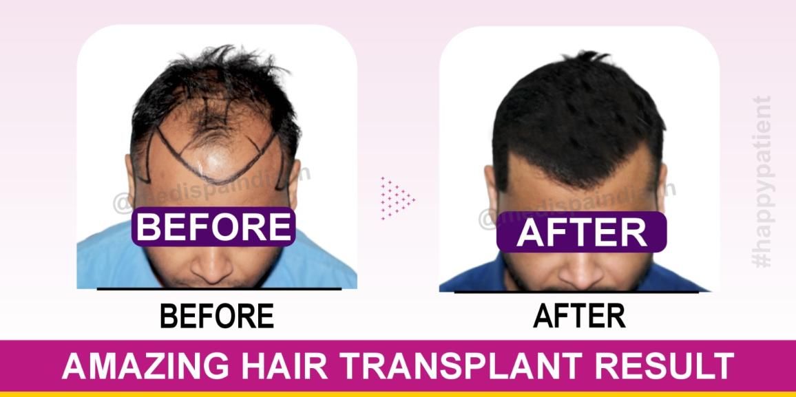 Is Hair Transplant in India Economical Than Other Countries?