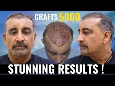 Best Hair Transplant Results in Australia & New Zealand when performed by Skilled Surgeon Dr Suneet