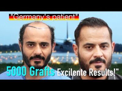 From Germany to India: 5000 Grafts Transform Grade 6 Baldness | 12-Month Hair Transplant Results