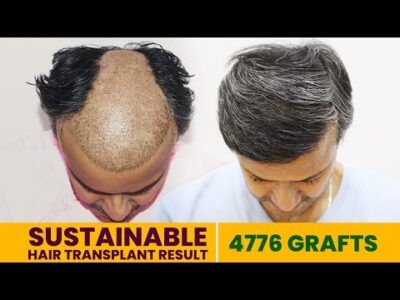 FINASTERIDE FREE Hair Transplant Results 2.5 Years Later Testimonial