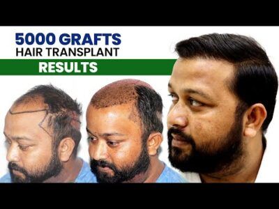 5000 Grafts Grade 6 Hair Transplant Results By Dr Suneet Soni at Medispa