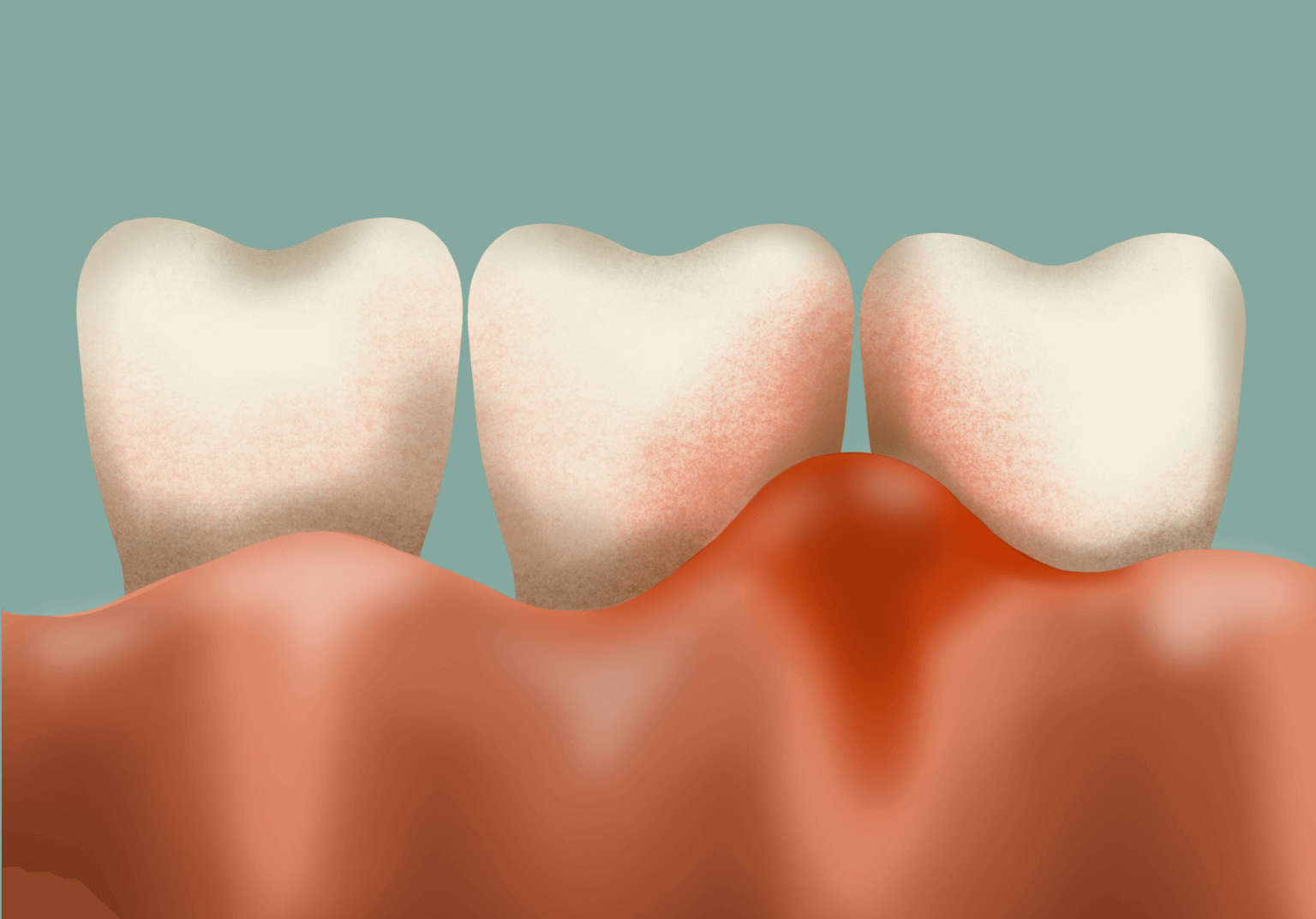 Periodontics Questions Dental Revision ExamineDental