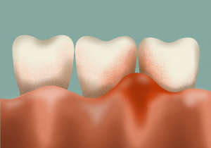 Periodontics Questions