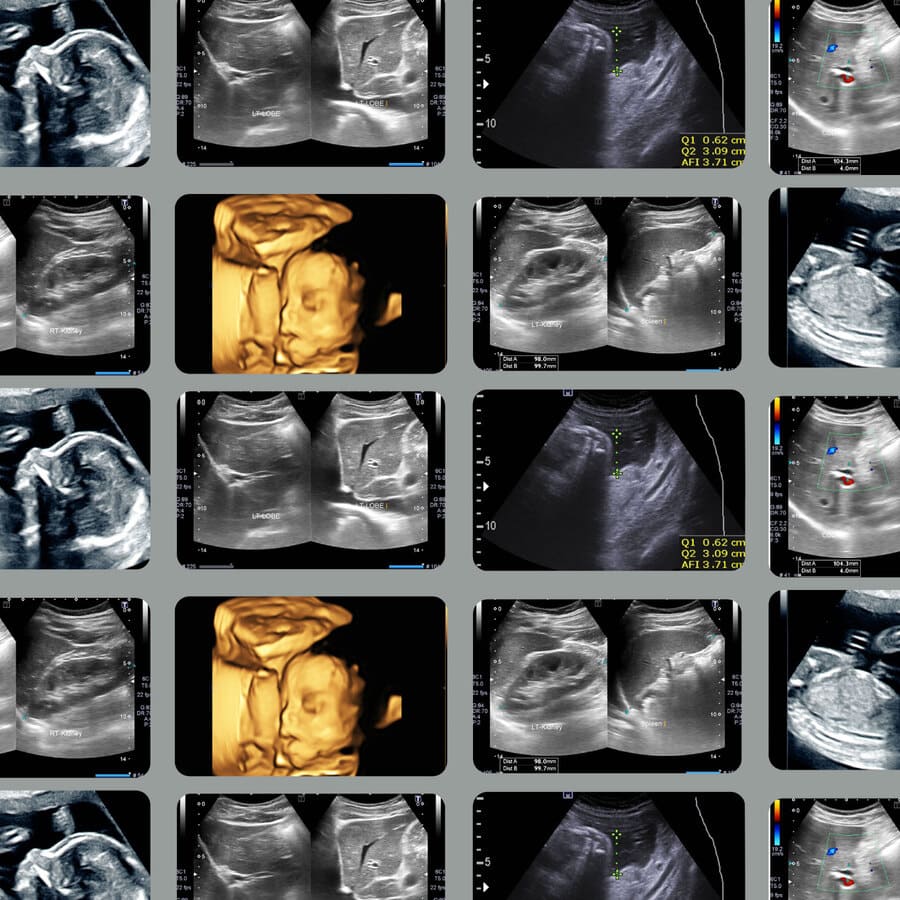 Radiografía, bebe, placas, crecimiento, feto