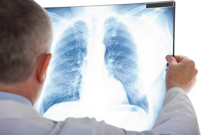 Mengenal Macam Macam Pneumonia