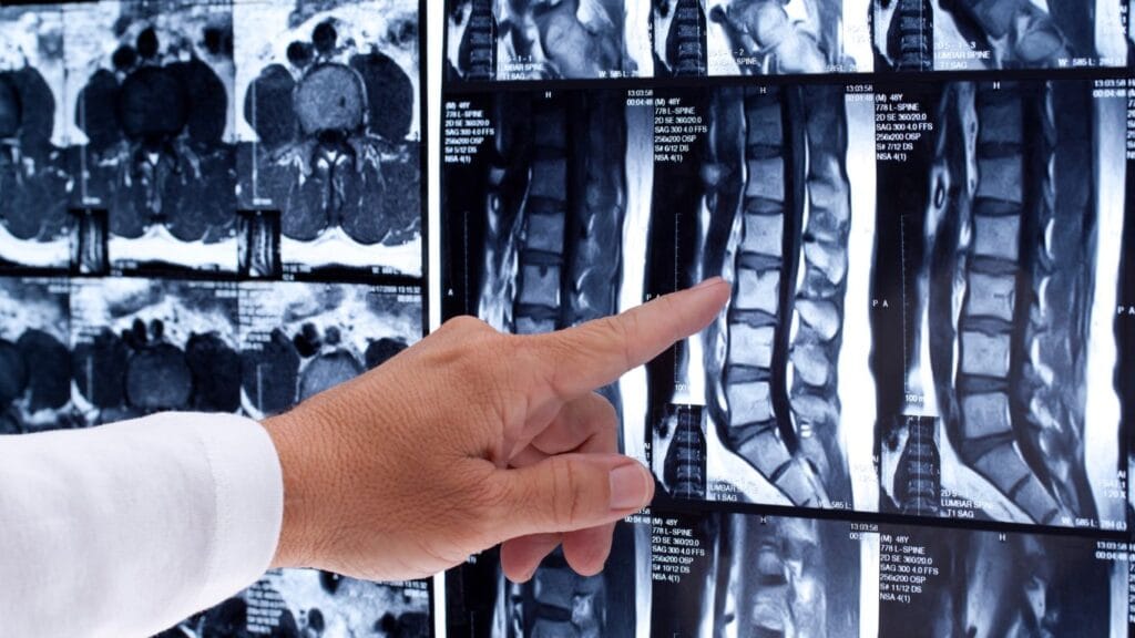 Resonancia Magnética Lumbar
