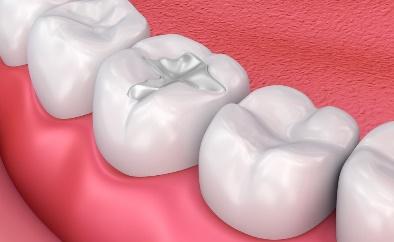 Types of Dental Fillings | Composite, Silver