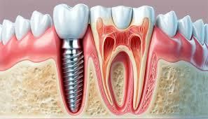 Discover Reliable Dental Implants for a Confident Smile | Kherani Dental at  Aspen - Your Calgary Dentist