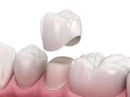 Dental Crowns in Prescott Valley | Larson Dental