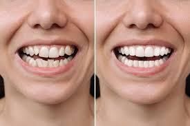 Is It Possible to Get Veneers with Crooked Teeth?