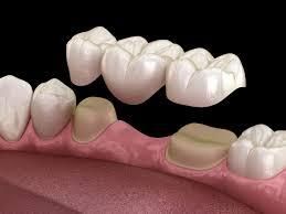 What Is A Dental Bridge? ~ Dr. Bharat ...