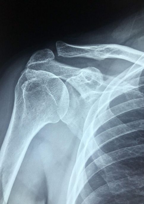 Bone health information talk