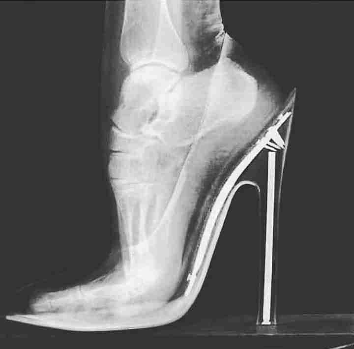 1. The X-ray below shows how wearing high heels exert considerable pressure on the bones, muscles an…