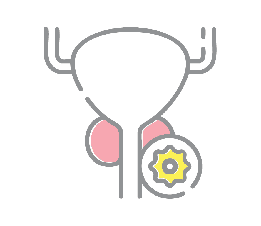 Prostate Cancer