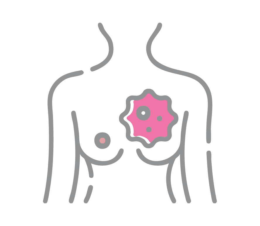 Breast Cancer
