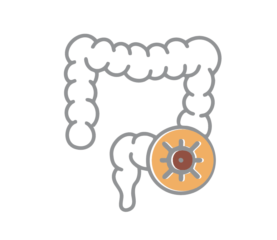 Colorectal Cancer