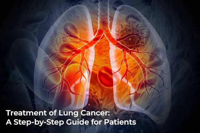 Treatment of Lung Cancer: A Step-by-Step Guide for Patients Treatment of Lung Cancer: A Step-by-Step Guide for Patients