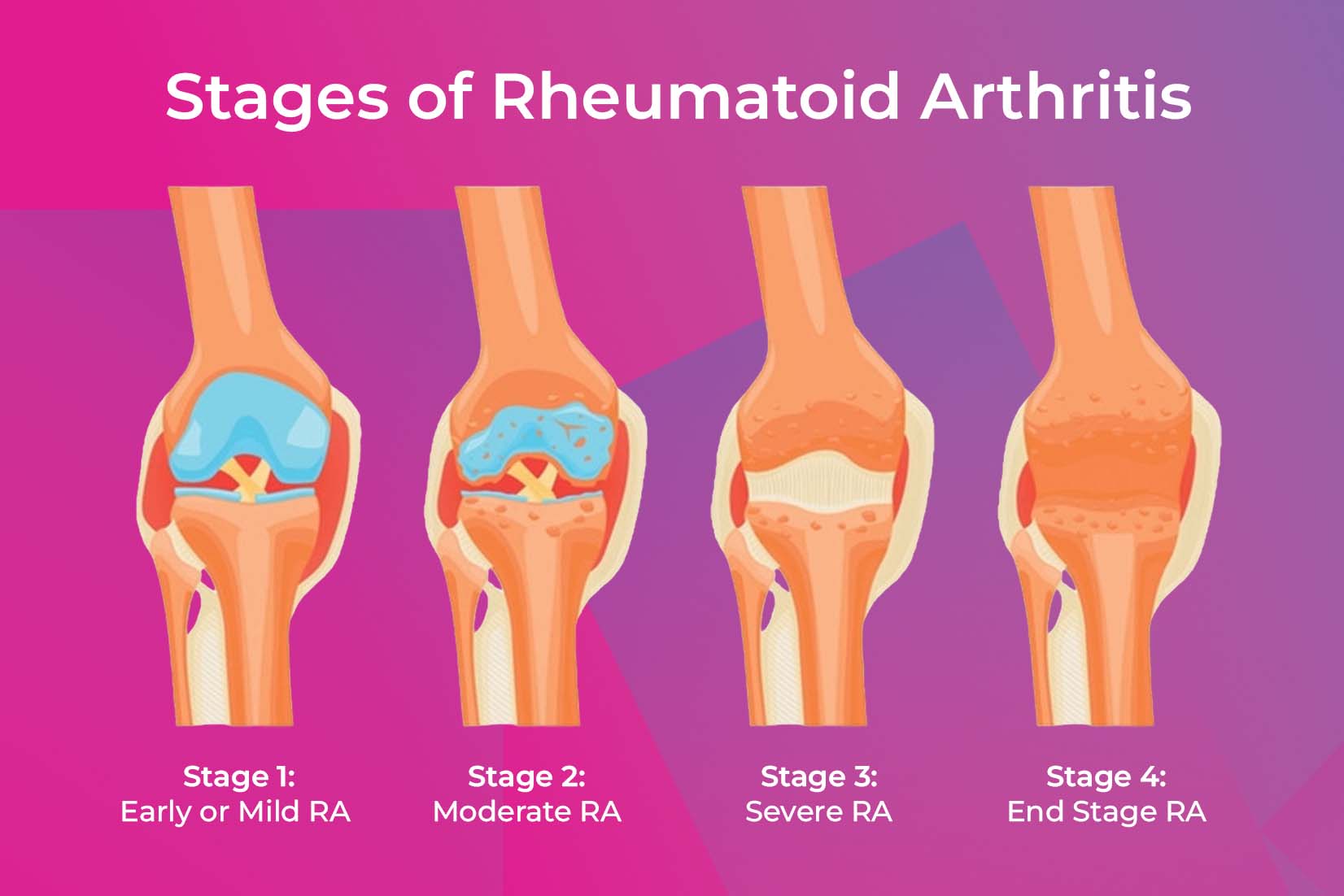 Stages of Rheumatoid Arthritis