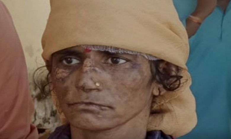 बहू को तवे से फूंका, अर्द्धनग्न रखा, खाना नहीं दिया 1 111 90
